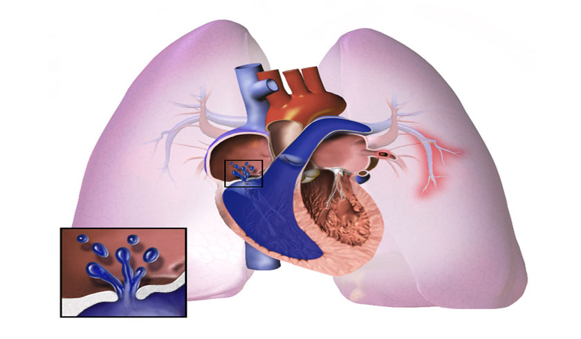 PAH treatment