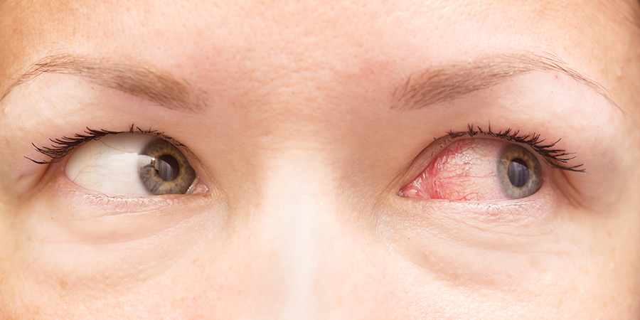 Pink eye/conjunctivitis