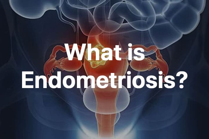 Endometriosis