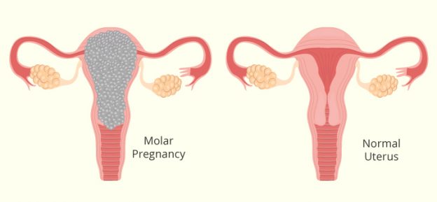 Molar-Pregnancy-Symptoms-Causes-And-Treatment-624x289