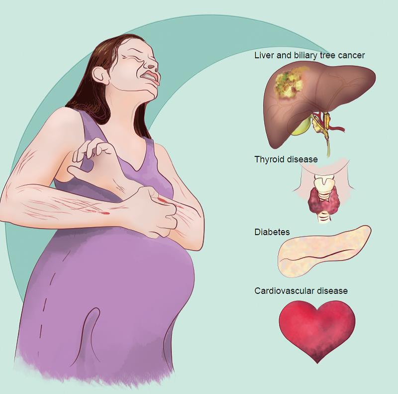 cholestasis of pregnancy